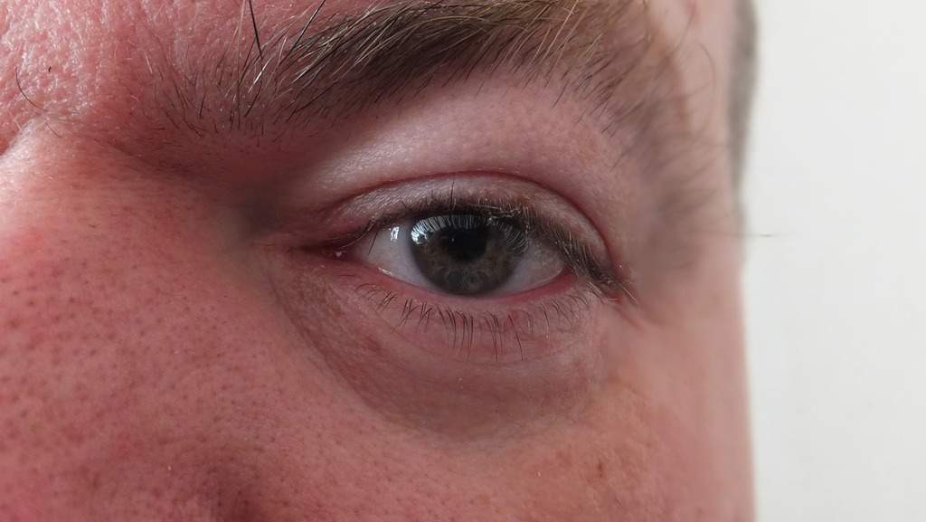 Qué cambia en tu piel a partir de los 50 imagen 10 Párpados-caídos-y-bolsas-bajo-los-ojos