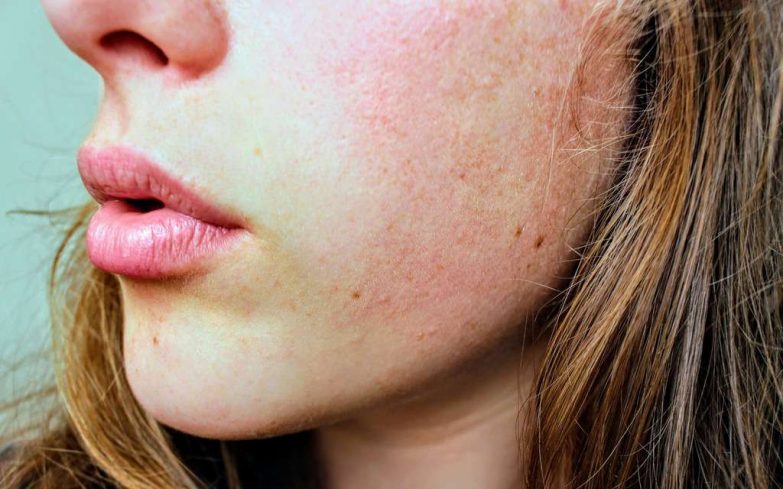 afecciones y alergia en la piel