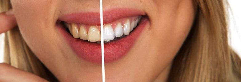 antes y después del uso del blanqueador dental
