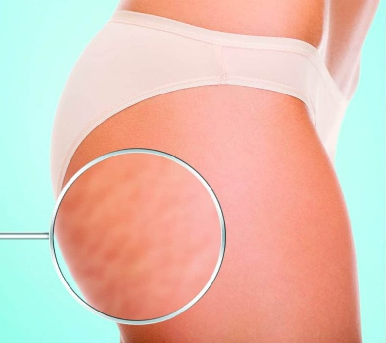 Equipo de radiofrecuencia facial Filfeel 3 en 1 a fondo imagen 2 celulitis grado 2